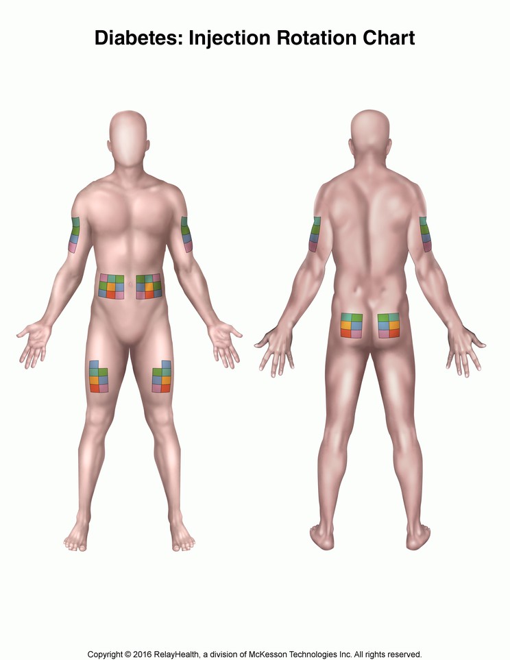 Diabetes, Injection Rotation Chart: Illustration