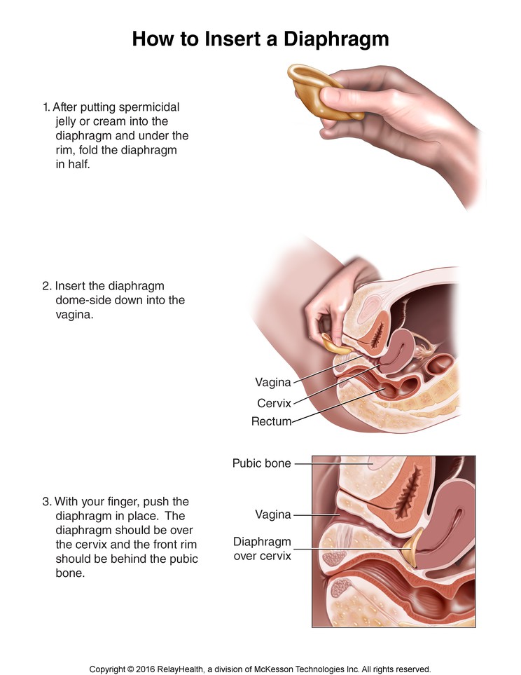 Diaphragm, How to Insert: Illustration