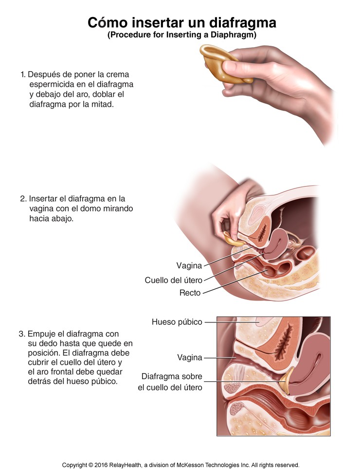 Diaphragm, How to Insert: Illustration