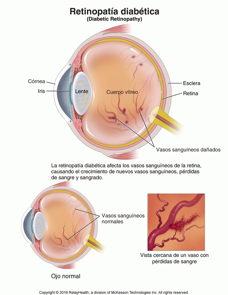 Diabetic Retinopathy: Illustration
