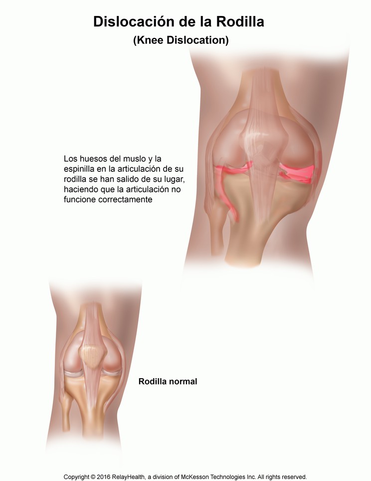 Dislocated Knee: Illustration