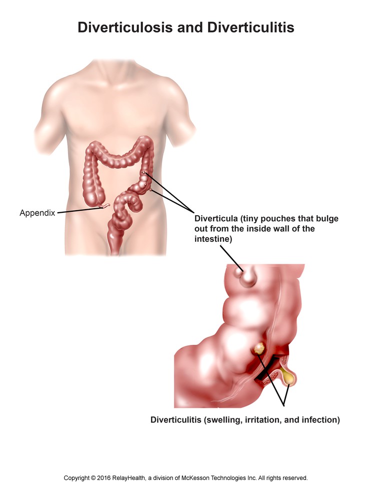 Diverticulosis: Illustration