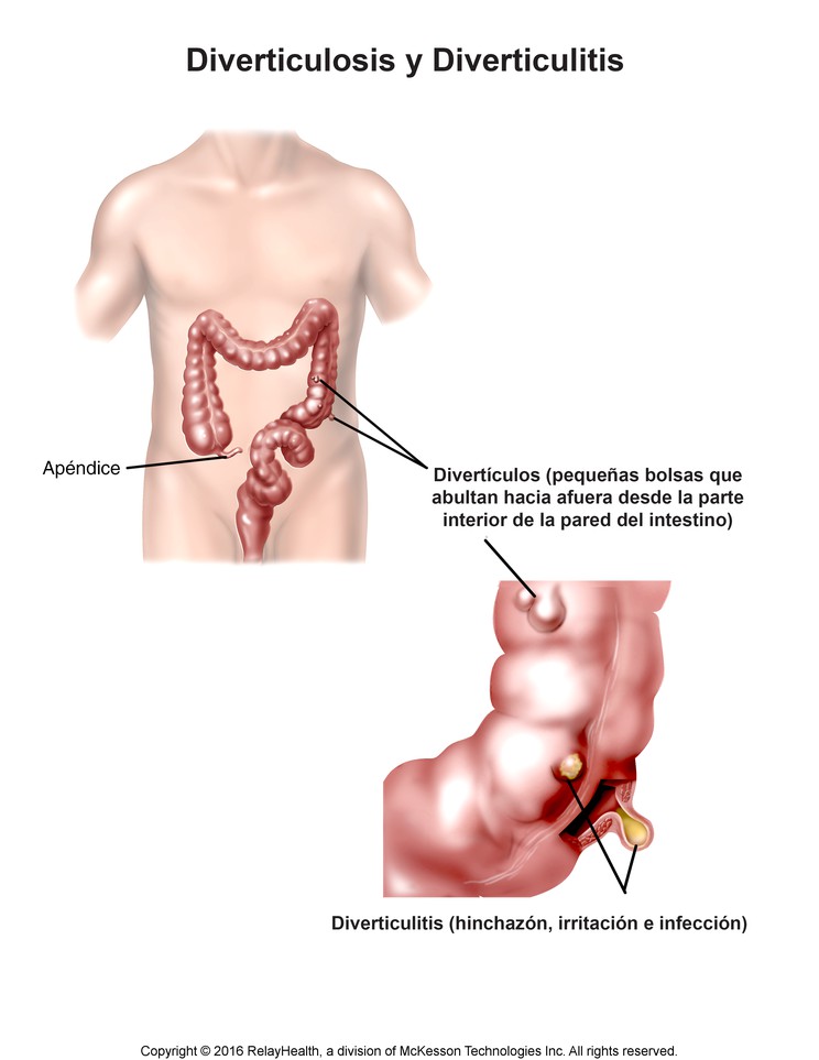Diverticulosis: Illustration
