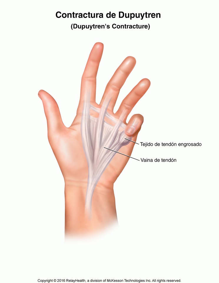Dupuytren's Contracture: Illustration