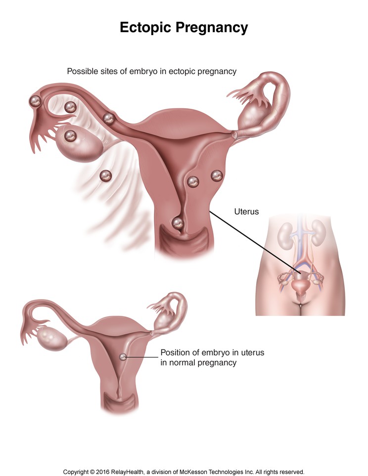 Ectopic Pregnancy: Illustration