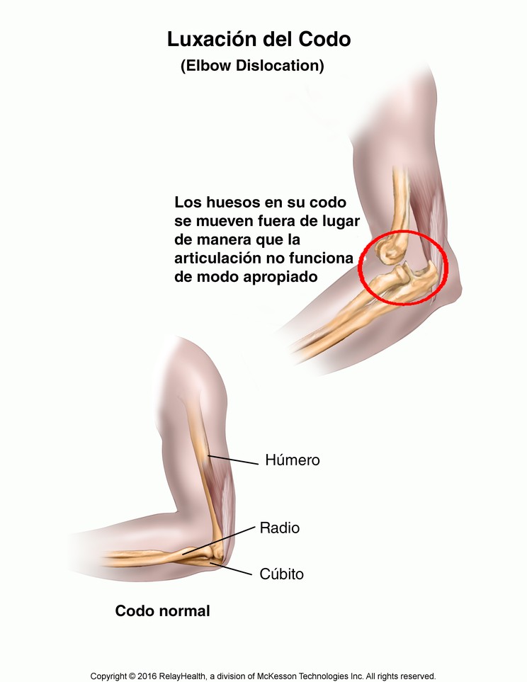 Dislocated Elbow: Illustration