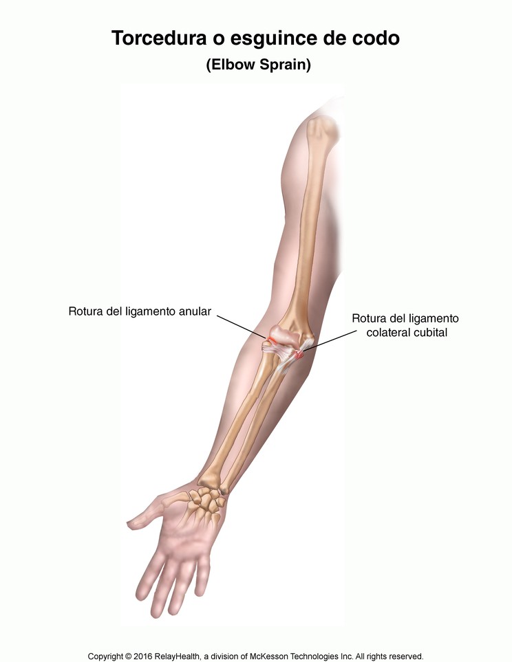 Elbow Sprain: Illustration