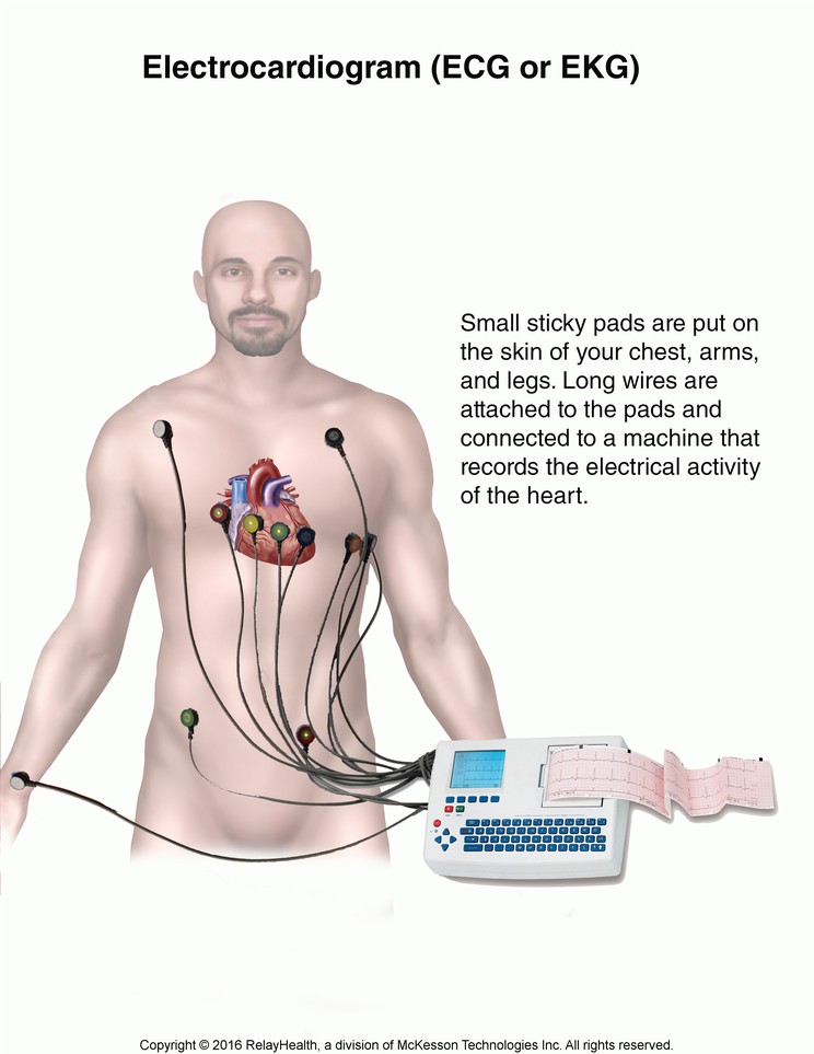 Electrocardiogram (ECG or EKG): Illustration