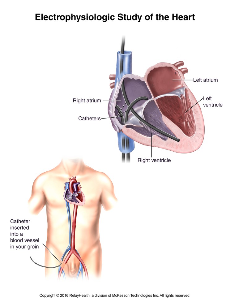 Electrophysiologic Study of the Heart--Catheter Positions: Illustration