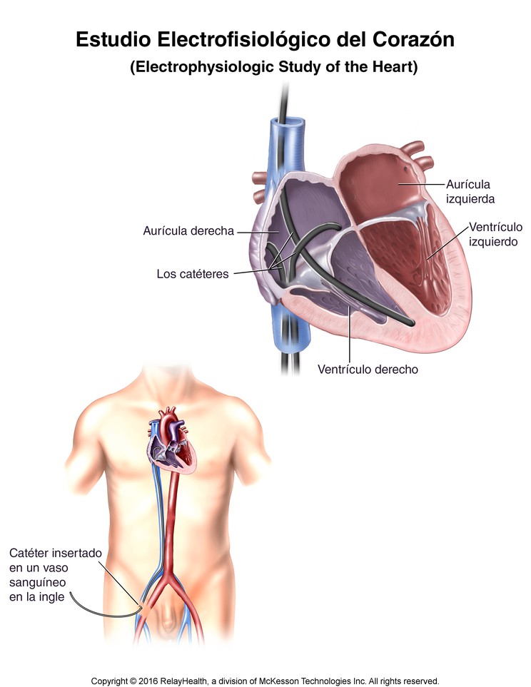 Electrophysiologic Study of the Heart--Catheter Positions: Illustration