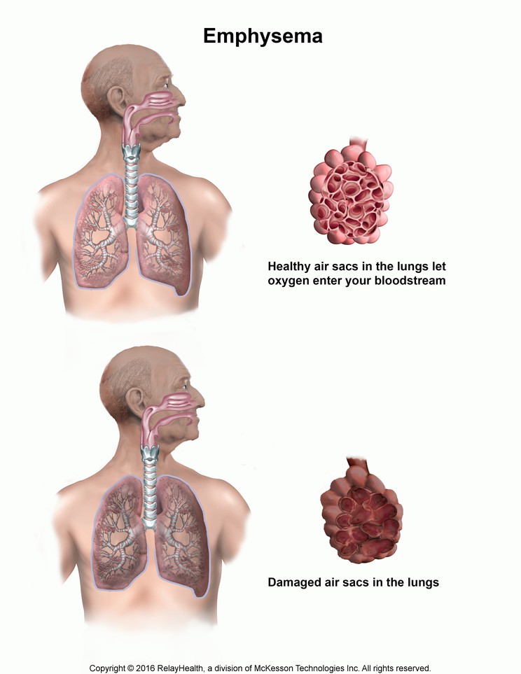 Emphysema: Illustration