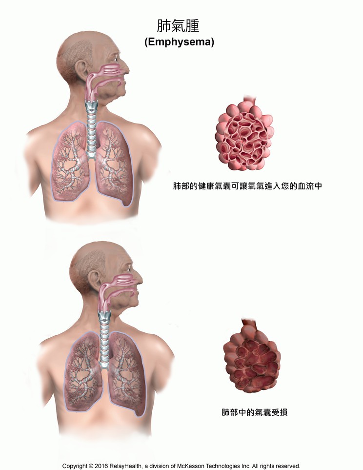 Emphysema: Illustration