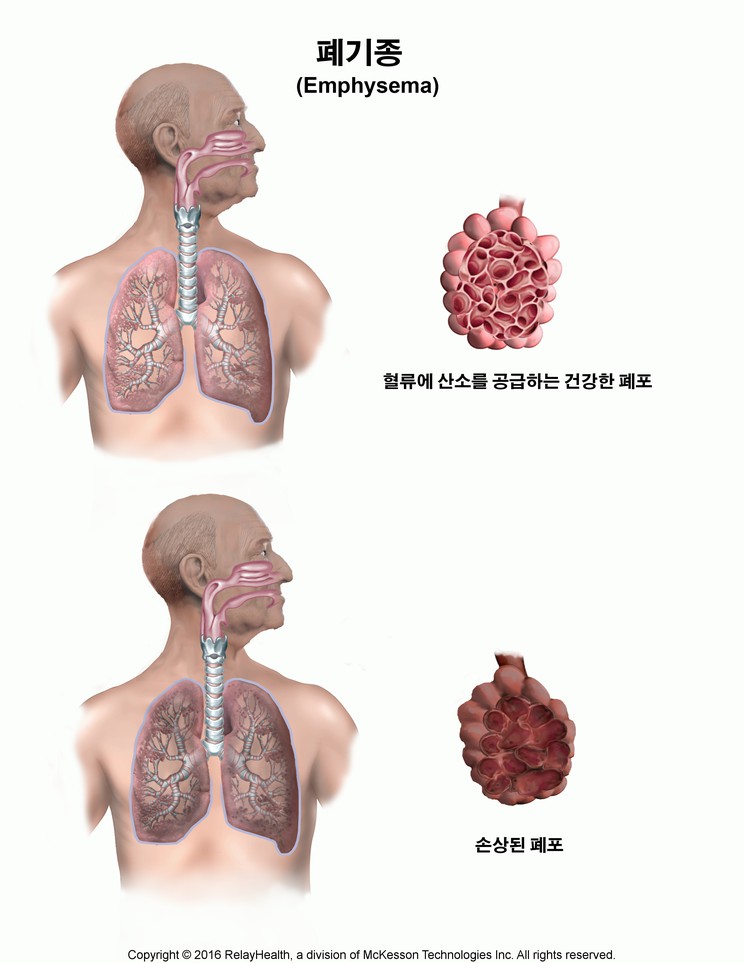 Emphysema: Illustration