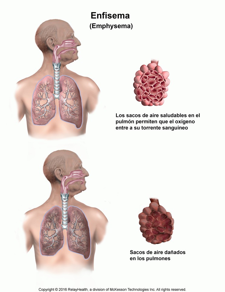 Emphysema: Illustration