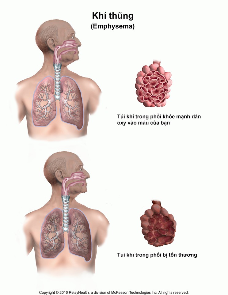 Emphysema: Illustration