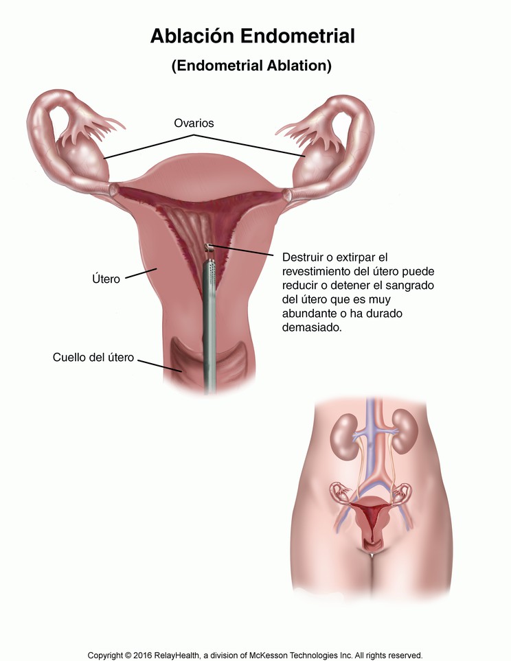 Endometrial Ablation: Illustration