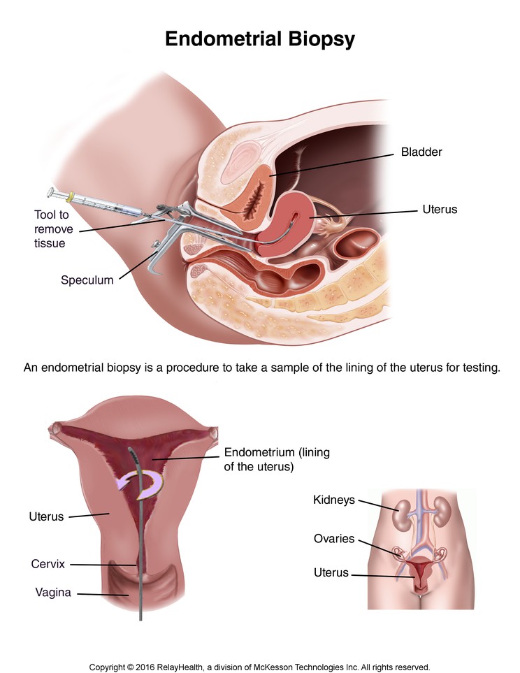 Endometrial Biopsy: Illustration