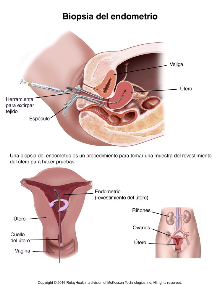 Endometrial Biopsy: Illustration