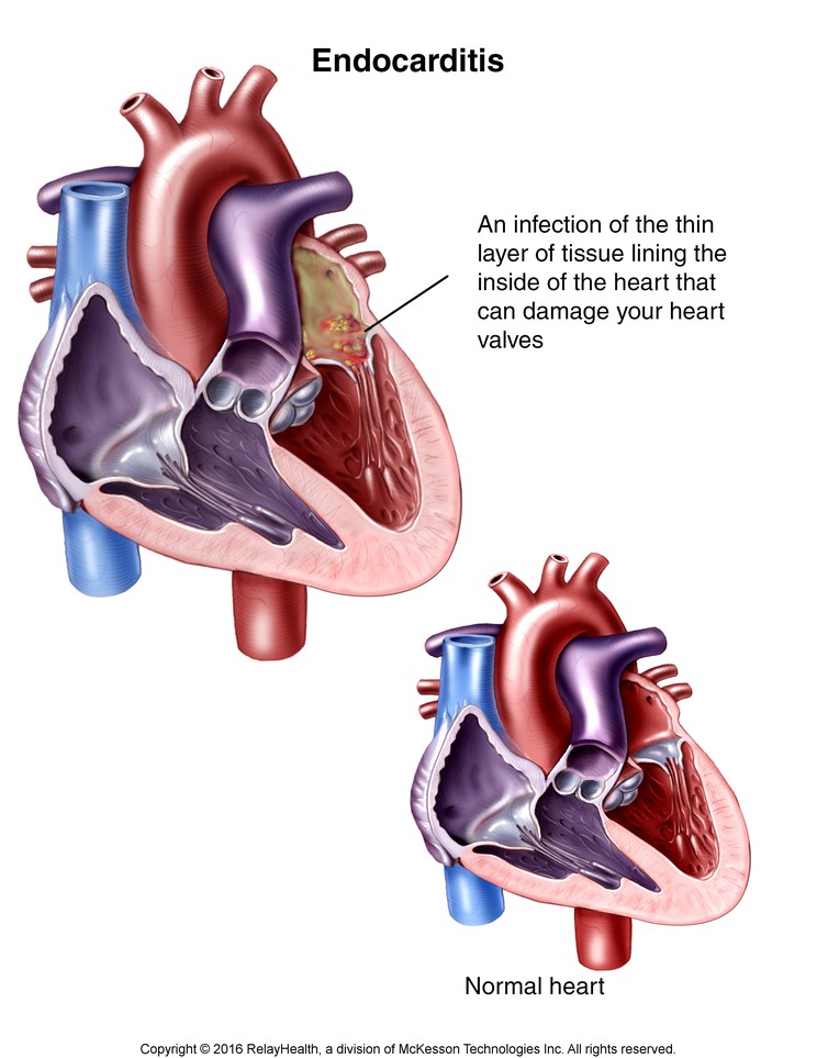 Endocarditis Heart Infection: Illustration