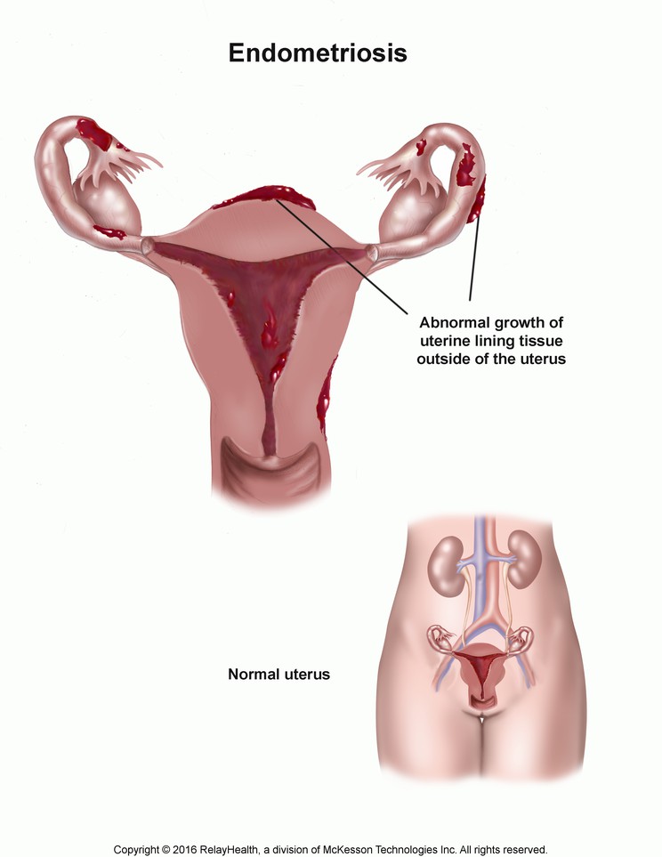Endometriosis: Illustration