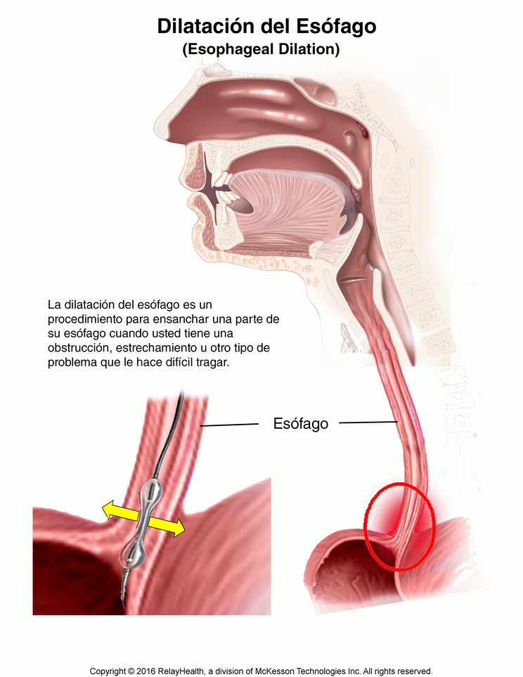 Esophageal Dilation: Illustration