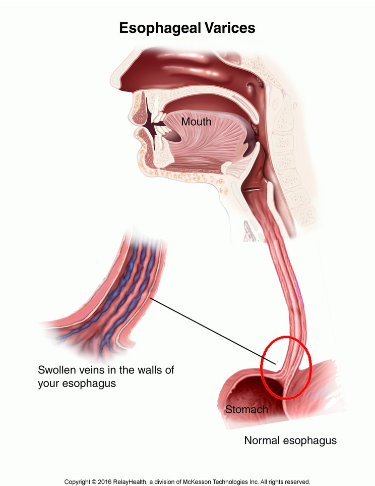 Esophageal Varices: Illustration