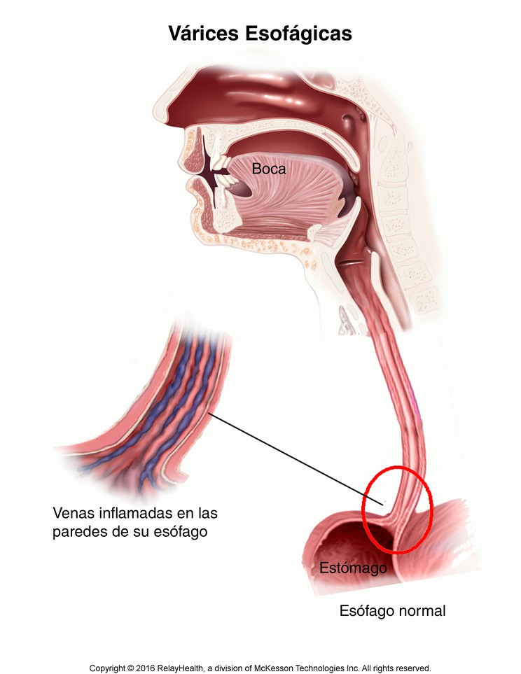 Esophageal Varices: Illustration