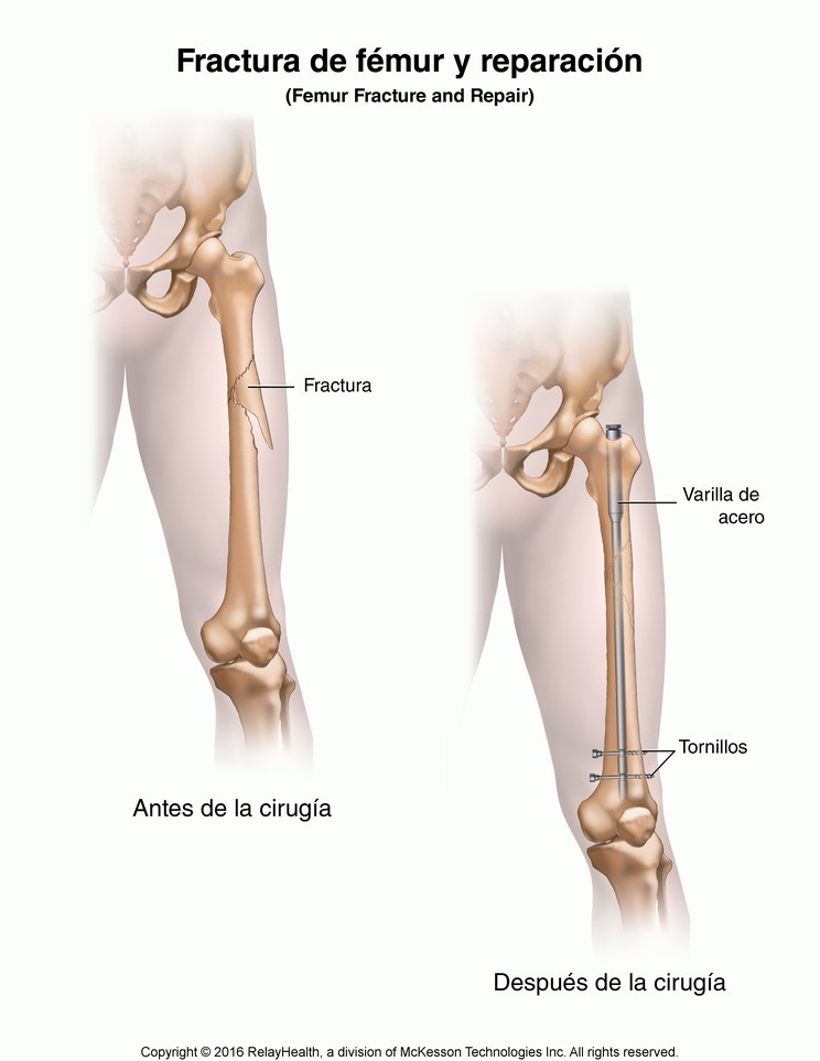 Femur Fracture and Repair: Illustration