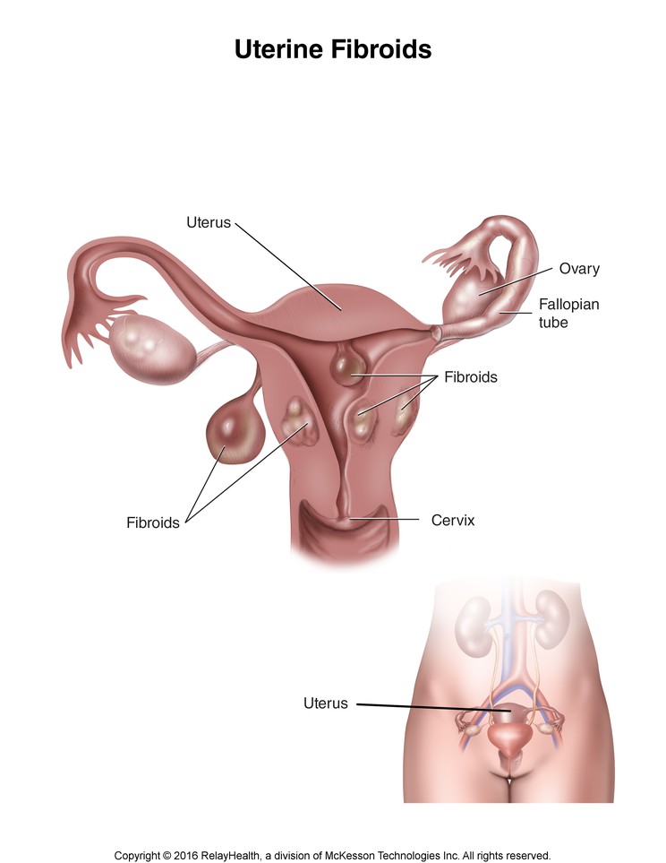 Uterine Fibroids: Illustration
