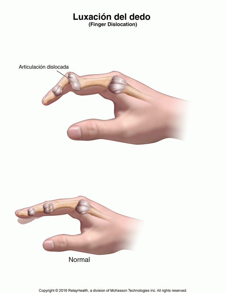 Finger Dislocation: Illustration