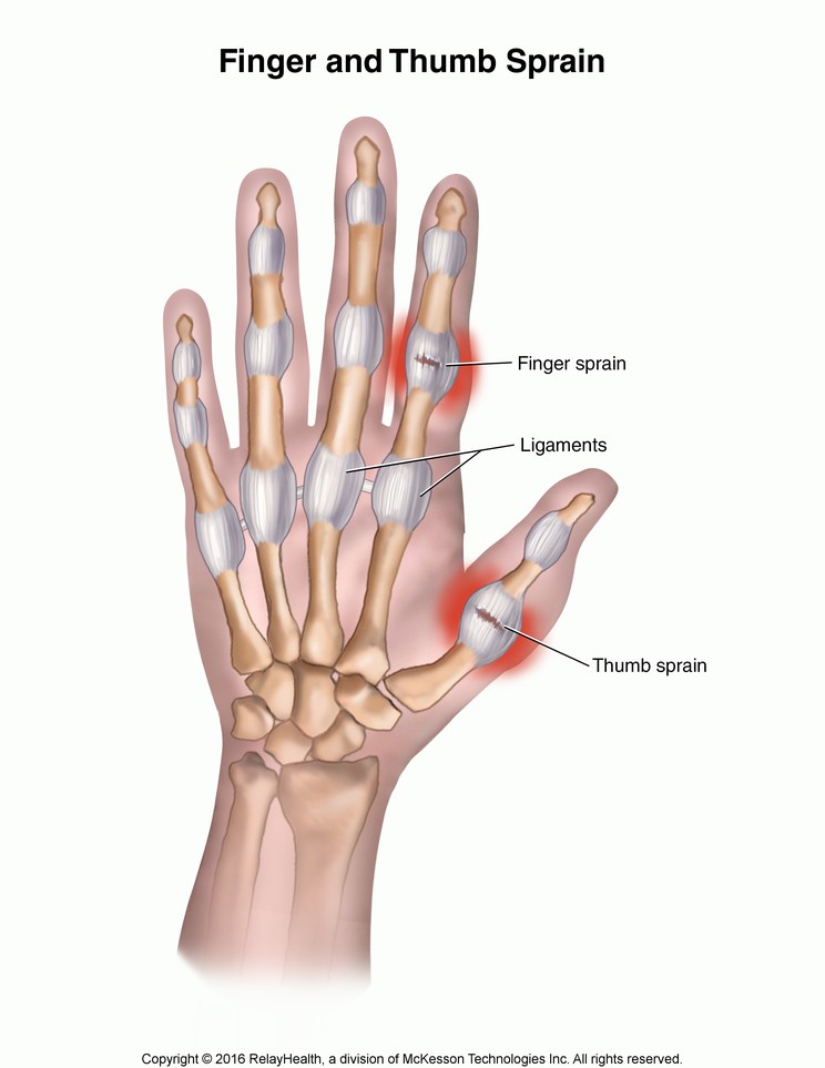 Finger and Thumb Sprain: Illustration