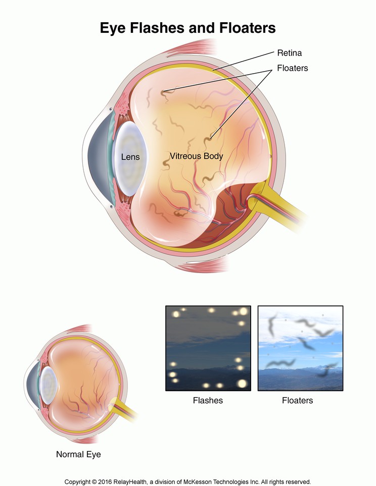 Eye Flashes and Floaters: Illustration