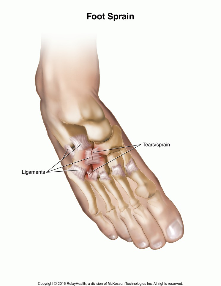 Foot Sprain: Illustration