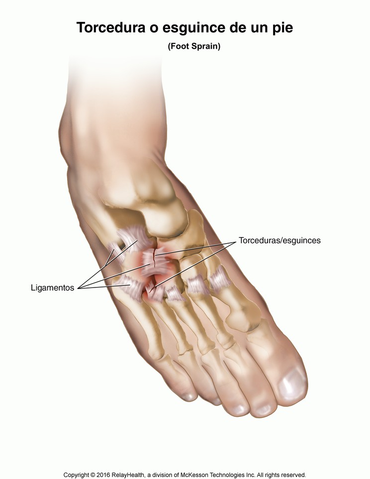 Foot Sprain: Illustration