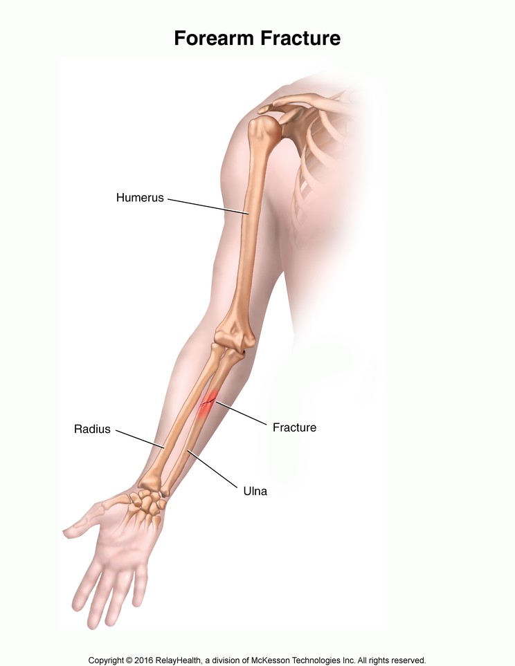 Forearm Fracture: Illustration