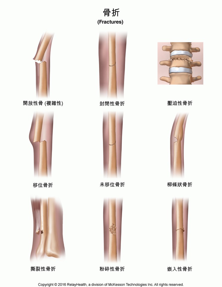 Fractures: Illustration