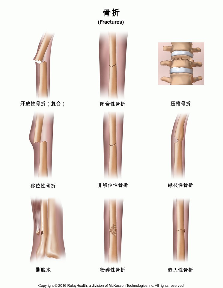 Fractures: Illustration