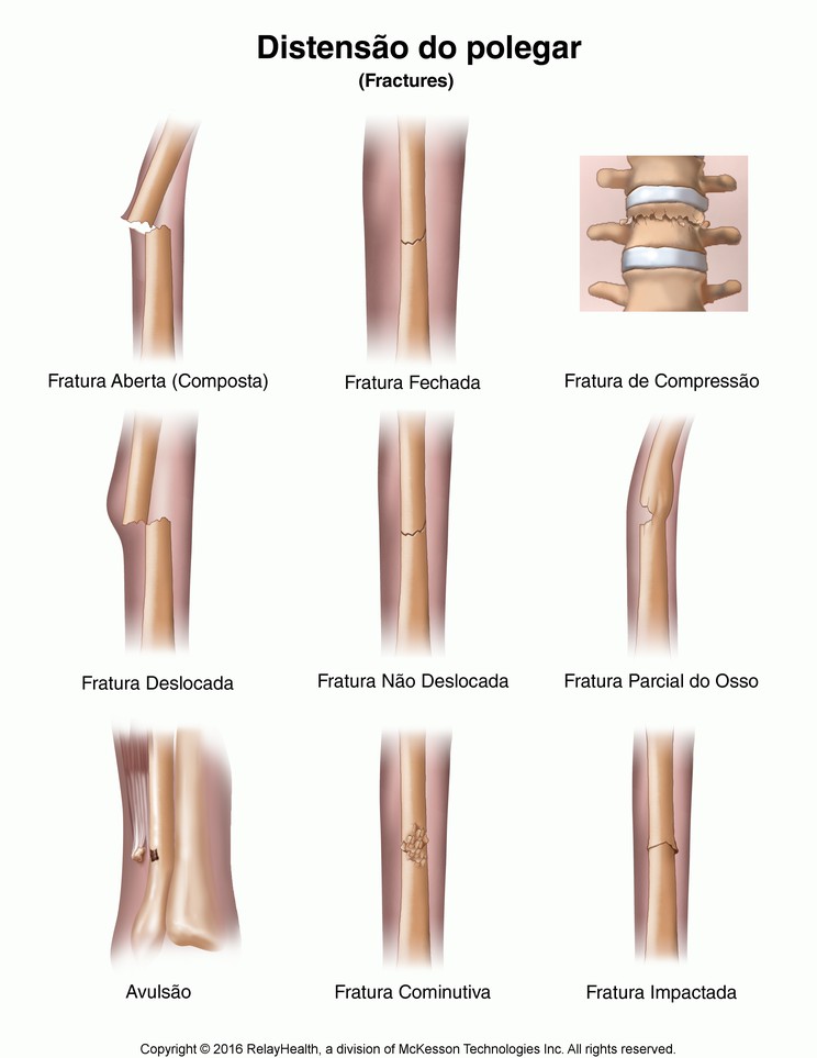 Fractures: Illustration