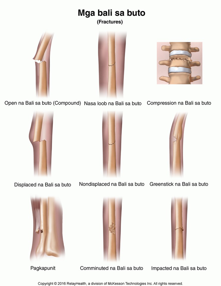Fractures: Illustration