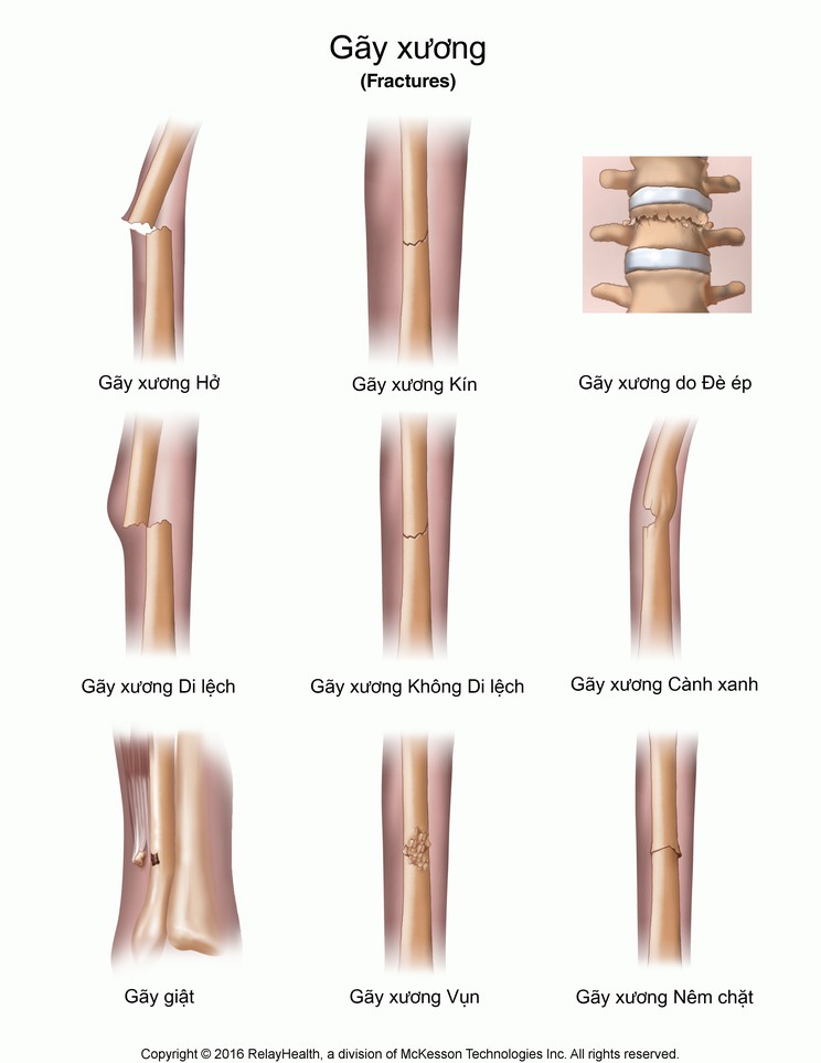 Fractures: Illustration