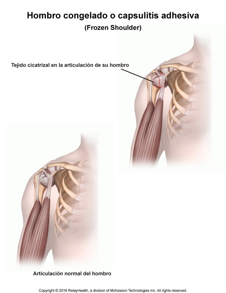 Frozen Shoulder: Illustration