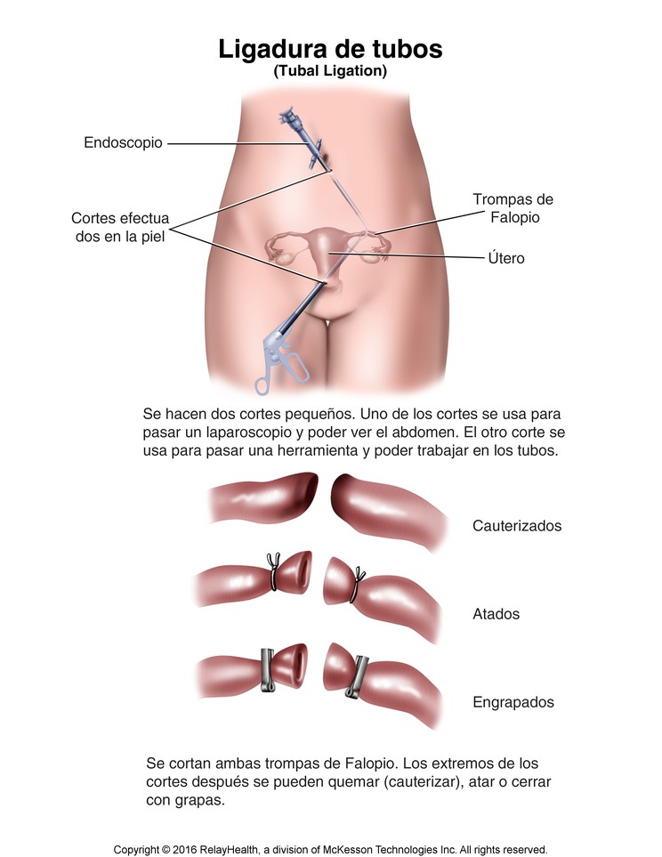 Tubal Ligation: Illustration