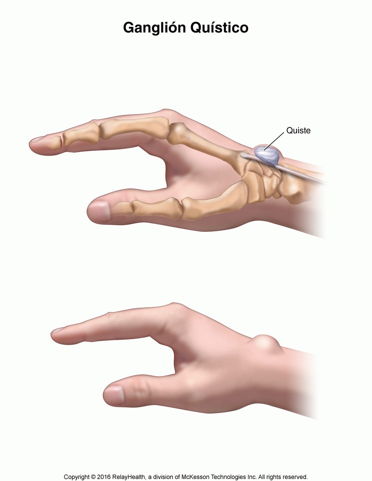 Ganglion Cyst: Illustration