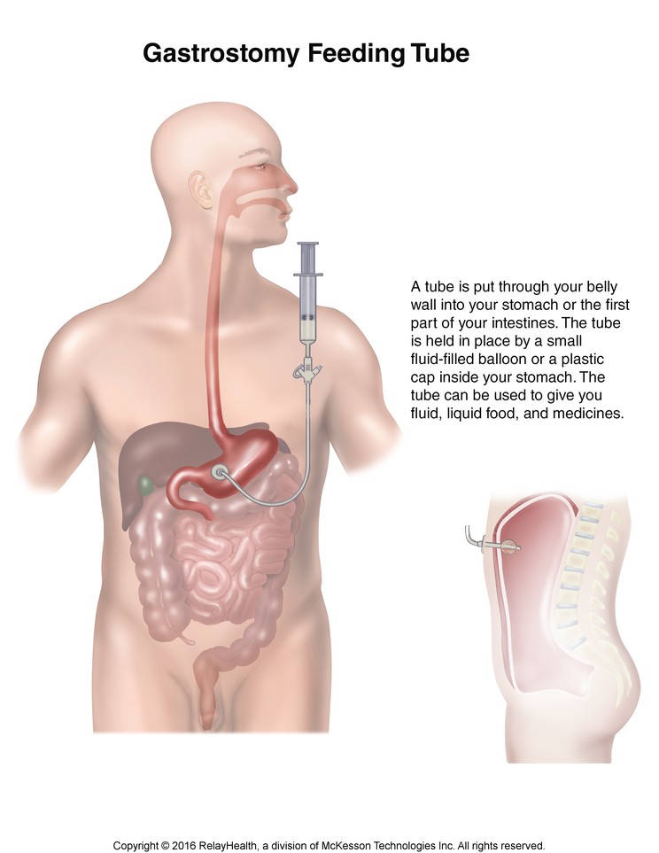 Gastrostomy Feeding Tube: Illustration