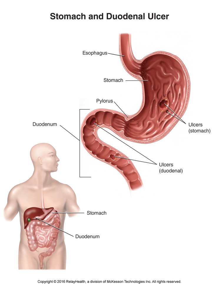 Stomach and Duodenal Ulcer: Illustration