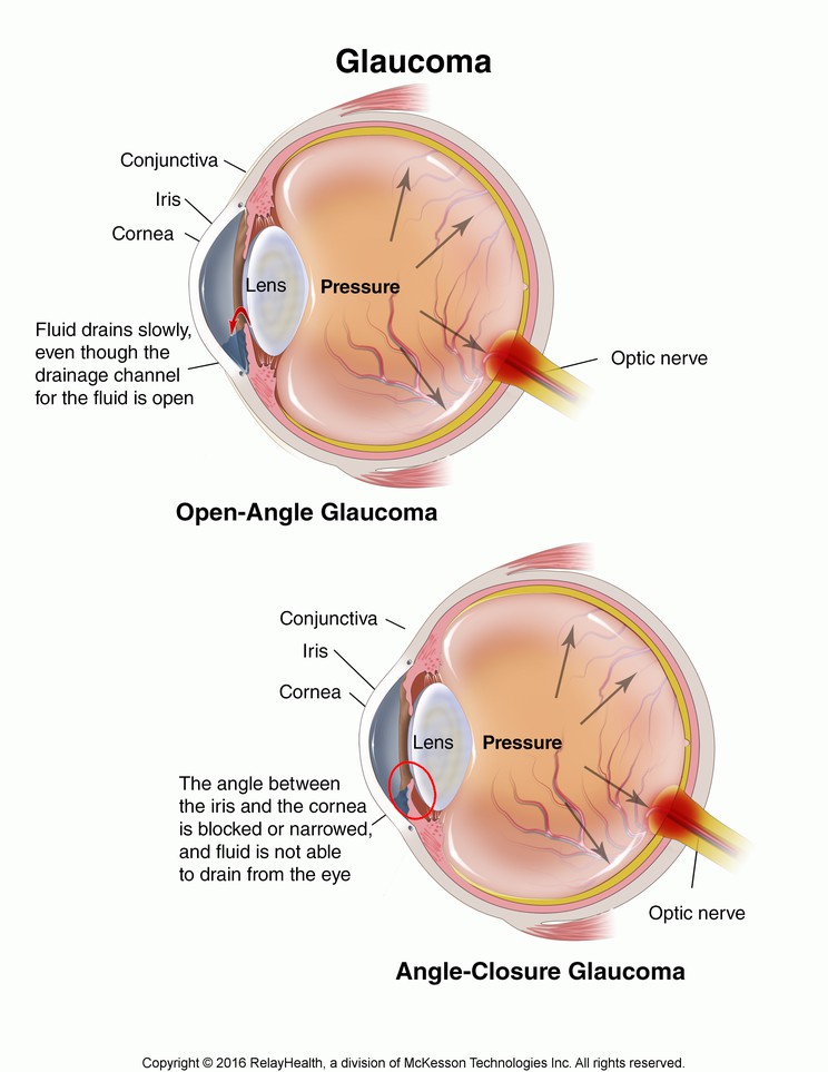 Glaucoma: Illustration