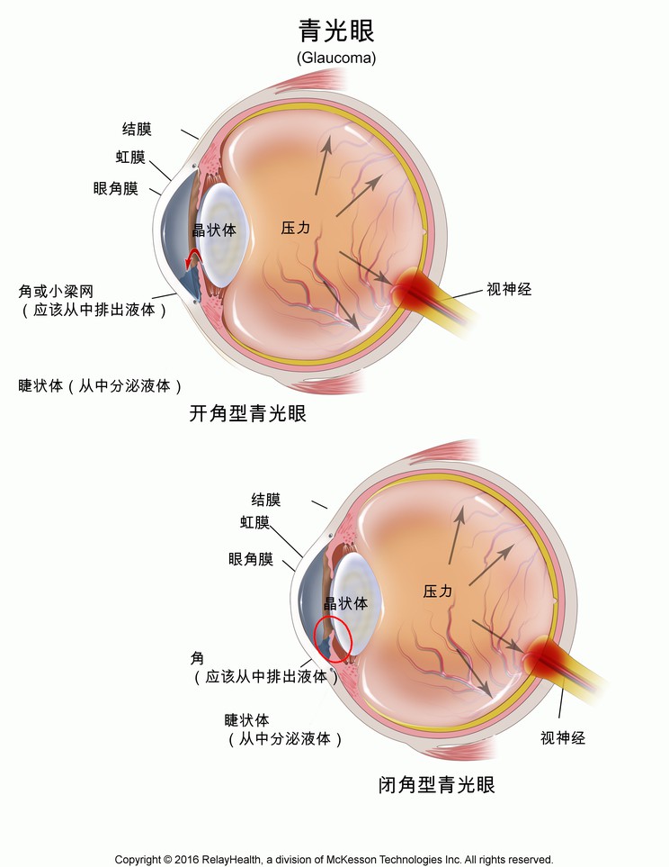 Glaucoma: Illustration