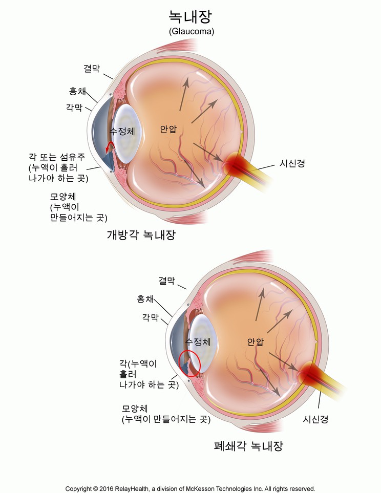 Glaucoma: Illustration