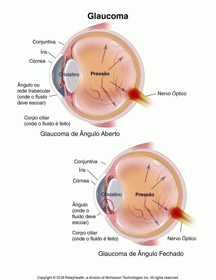 Glaucoma: Illustration