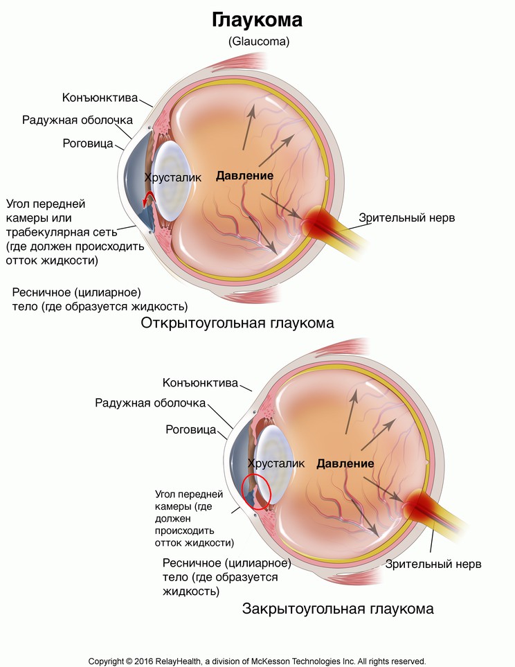 Glaucoma: Illustration
